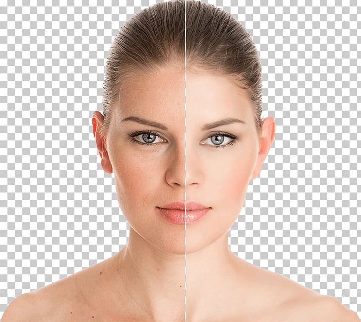 Dermatology Clinic Botulinum Toxin Rhytidectomy Medicine PNG, Clipart, Beauty, Before And After, Botulinum Toxin, Brown Hair, Cheek Free PNG Download