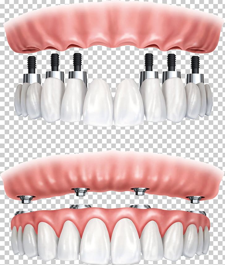 All-on-4 Dental Implant Dentistry Dentures PNG, Clipart, Allon4, Bridge, Burnaby, Dental, Dental Implant Free PNG Download