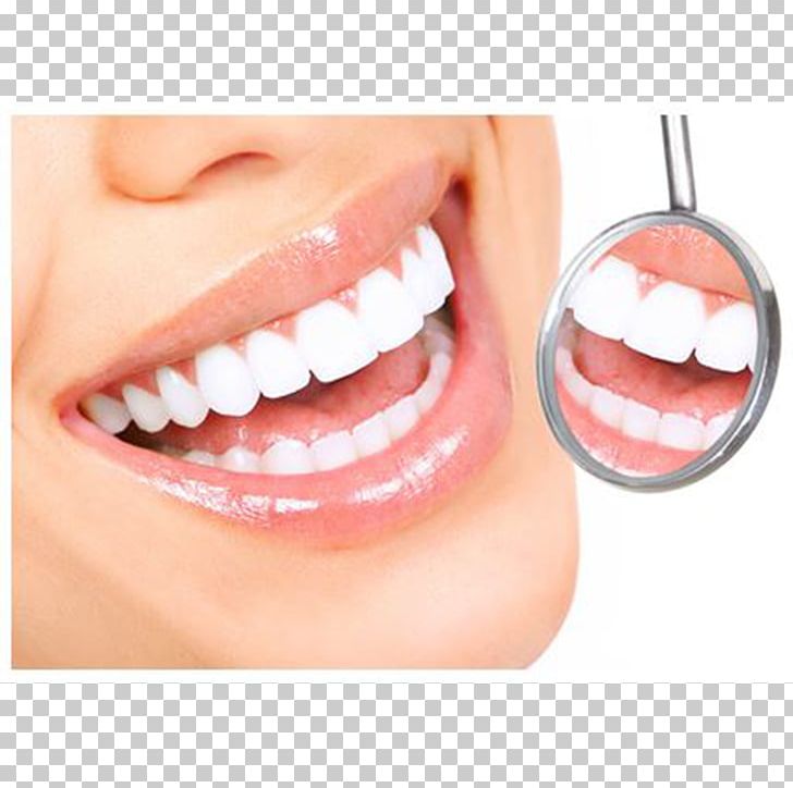 Cosmetic Dentistry Periodontal Disease Dental Surgery PNG, Clipart, Cheek, Chin, Cosmetic Dentistry, Crown, Dental Free PNG Download