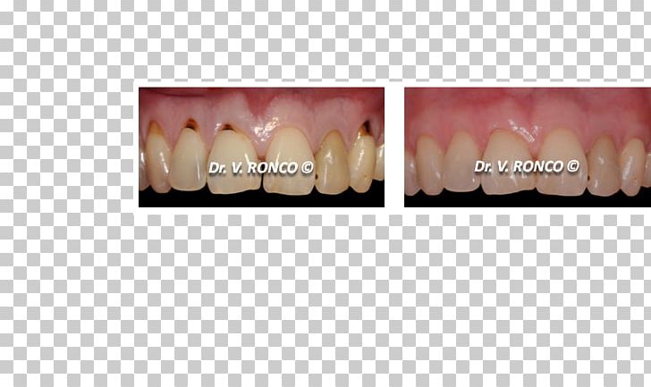 Tooth Dentist Gums Gingival Graft Dental Implant PNG, Clipart, Cosmetic Dentistry, Crown, Dental Extraction, Dental Implant, Dental Restoration Free PNG Download