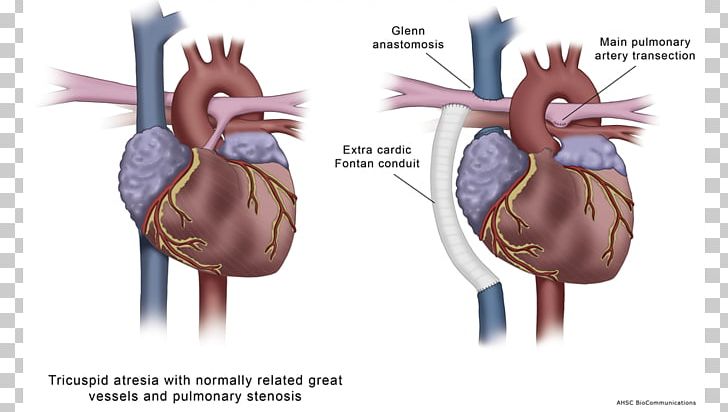 Medical Illustration Medicine Cardiology Atresia PNG, Clipart, Atresia, Biological Illustration, Cardiology, Coronary Artery Disease, Health Free PNG Download