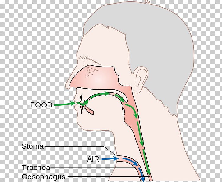 Laryngectomy Voice Prosthesis Larynx Nose PNG, Clipart, Abdomen, Angle, Arm, Bone, Chee Free PNG Download
