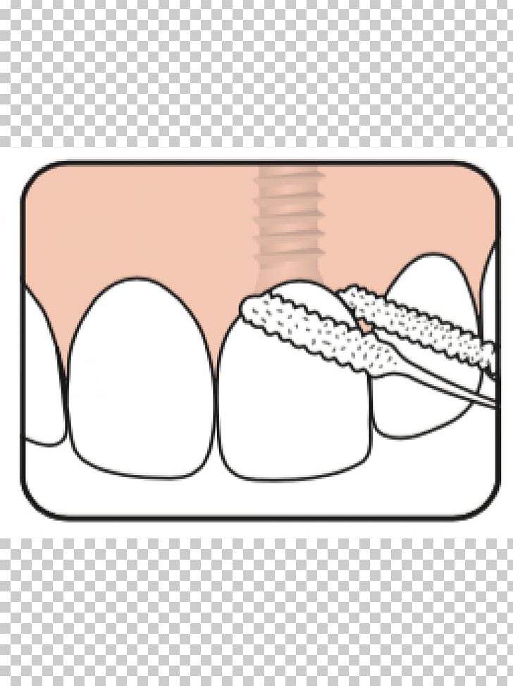 Dental Floss Nit Tooth Dental Implant Jaw PNG, Clipart, Area, Cartoon, Cleaning, Dental Consonant, Dental Floss Free PNG Download
