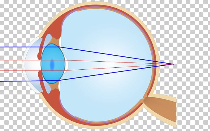 Eye 後遺障害 Ophthalmology Medical Device Contact Lenses PNG, Clipart, Angle, Circle, Contact Lens, Contact Lenses, Disability Free PNG Download
