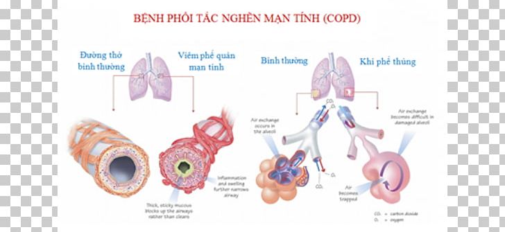 Regenerative Medicine Stem Cell Chronic Obstructive Pulmonary Disease Stem-cell Therapy PNG, Clipart, Bronchitis, Cell, Chronic Disease, Disease, Ear Free PNG Download