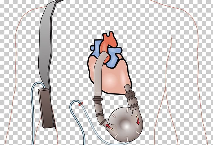 Ventricular Assist Device Heart Transplantation Ventricle Heart Failure PNG, Clipart, Arm, Artificial Heart, Blood, Cardiology, Cartoon Free PNG Download