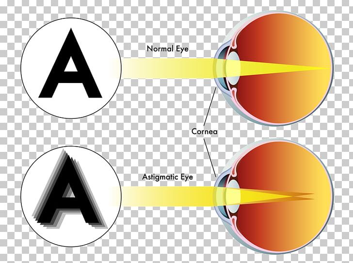 LASIK Astigmatism Refractive Surgery Eye Surgery PNG, Clipart, Angle, Astigmatism, Brand, Circle, Cornea Free PNG Download