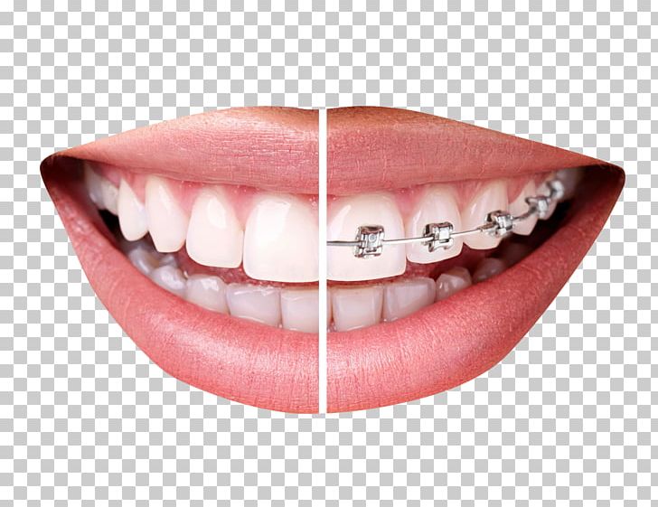 Dental Braces Clear Aligners Orthodontics Tooth Dentistry PNG, Clipart, Braces, Clear Aligners, Clinic, Dental, Dental Braces Free PNG Download