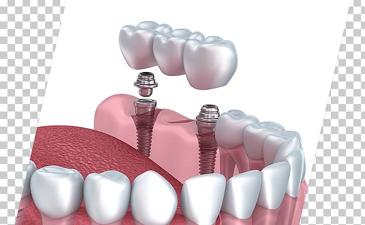 Dental Implant Cosmetic Dentistry Bridge PNG, Clipart, Bridge, Cosmetic Dentistry, Crown, Dental, Dental Implant Free PNG Download