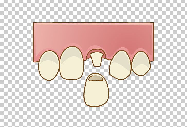 Sakayori Dental Clinic Dentistry 歯科 歯冠継続歯 PNG, Clipart, Dental Clinic, Dental Technician, Dentist, Dentistry, Dentures Free PNG Download
