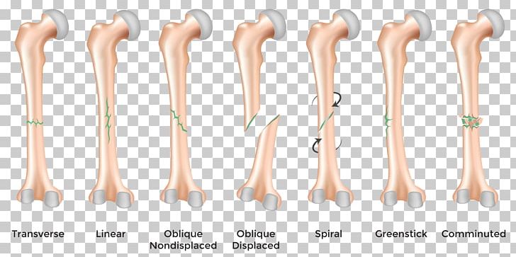 Bone Fracture Bone Healing Femoral Fracture Injury PNG, Clipart, Ankle Fracture, Arm, Bone, Bone Disease, Bone Fracture Free PNG Download
