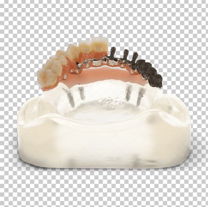 Tooth Dentistry Bridge Dentures Dental Implant PNG, Clipart, 3d Printing, 3d Systems, Bridge, Dental Implant, Dental Surgery Free PNG Download