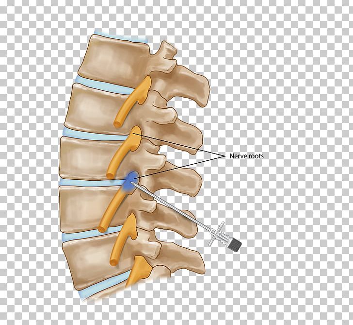 Nerve Root Injection Vertebral Column Nerve Block PNG, Clipart, Ache, Angle, Cervical Vertebrae, Epidural Steroid Injection, Facet Joint Free PNG Download