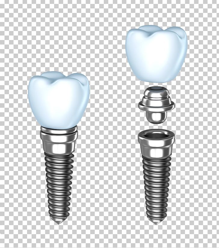 Dental Implant Dentistry Dentures Human Tooth PNG, Clipart, Abutment, Body Jewelry, Bridge, Cosmetic Dentistry, Crown Free PNG Download
