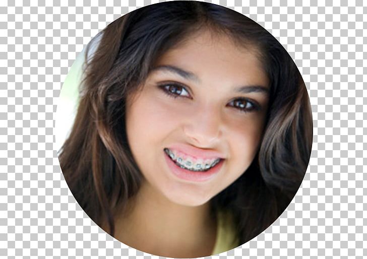 Orthodontics Dental Braces Dentistry Tooth PNG, Clipart, Adolescence, American Board Of Orthodontics, Beauty, Black Hair, Brown Hair Free PNG Download