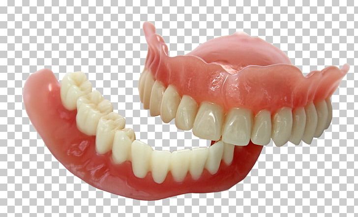 3D Printing Dentures EnvisionTEC Dentistry PNG, Clipart, 3d Printing, Bridge, Cadcam Dentistry, Crown, Dental Free PNG Download