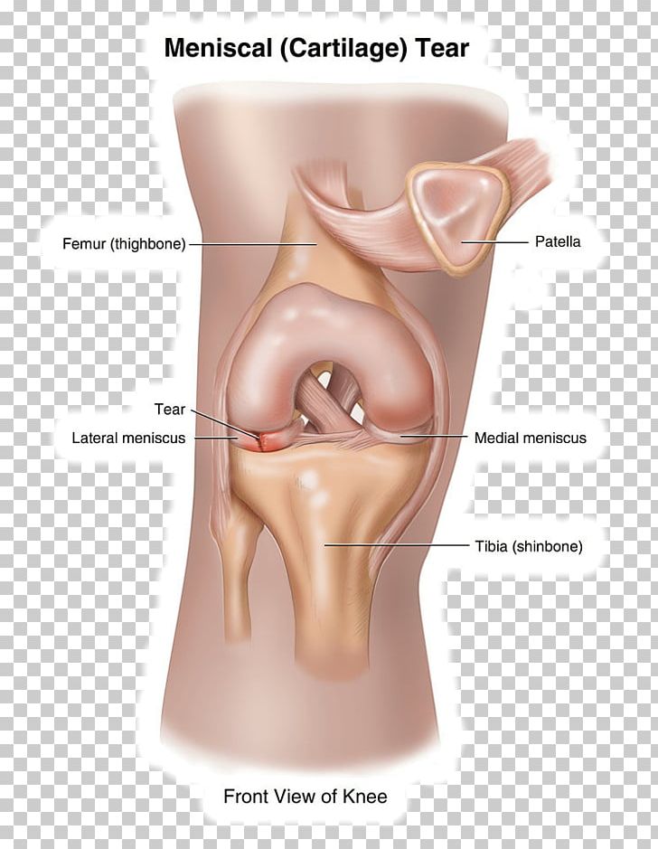 Knee Pain Meniscus Joint Ruptur PNG, Clipart, Ache, Arthritis, Arthroscopy, Bursitis, Cheek Free PNG Download