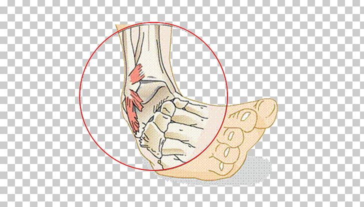 Sprained Ankle Ligament Injury PNG, Clipart, Angle, Ankle, Arm, Foot, Hand  Free PNG Download