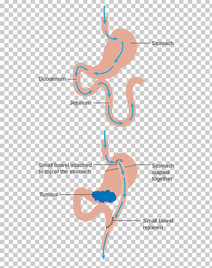 Gastric Bypass Surgery Sleeve Gastrectomy Obesity PNG, Clipart, Angle, Arm, Bypass, Bypass Surgery, Diagram Free PNG Download