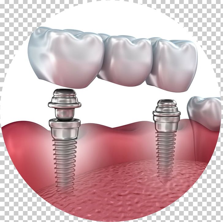 Bridge Dental Implant Dentistry Dentures PNG, Clipart, Bridge, Crown, Dental Implant, Dental Implants, Dental Prosthesis Free PNG Download