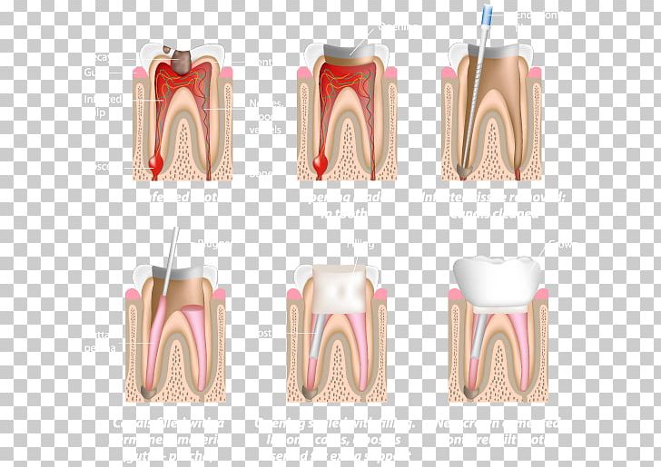 Endodontic Therapy Root Canal Endodontics Dentistry PNG, Clipart, Ache, Dental Surgery, Dentist, Dentistry, Disease Free PNG Download