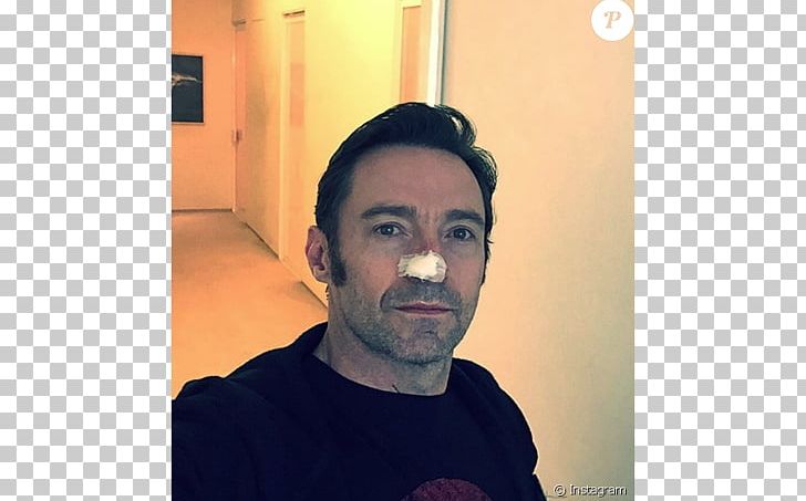 Hugh Jackman Skin Cancer Nose Surgery PNG, Clipart, Basalcell Carcinoma, Beard, Caitlyn Jenner, Cancer, Celebrities Free PNG Download