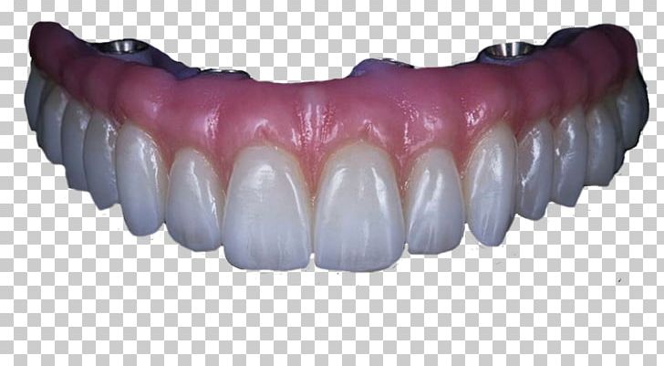 Human Tooth Angelet De Les Dents Dentures Dental Implant PNG, Clipart, Angelet De Les Dents, Animaatio, Crown, Dandelion, Dental Implant Free PNG Download