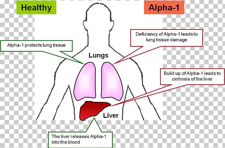Chronic Obstructive Pulmonary Disease Health Lung Finger PNG, Clipart, Abdomen, Alpha 1antitrypsin Deficiency, Angle, Arm, Circle Free PNG Download