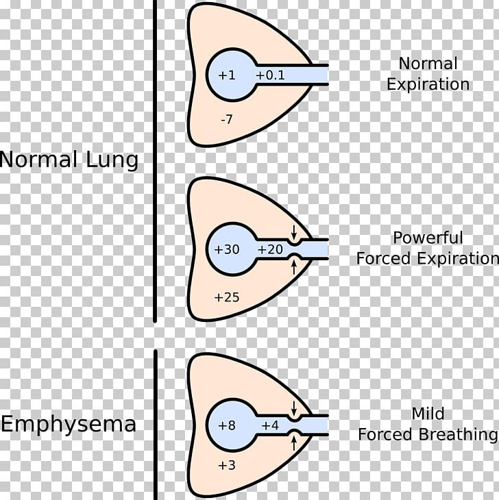 Dynamic Compression Of The Airways Lung Pulmonary Compliance