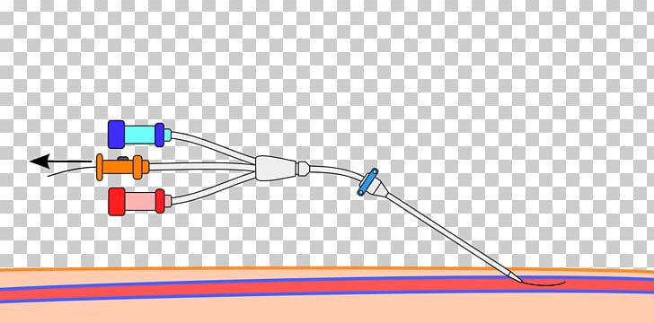 Seldinger Technique Central Venous Catheter Peripheral Venous Catheter Trocar PNG, Clipart, Angiography, Angle, Arterial Line, Artery, Cable Free PNG Download