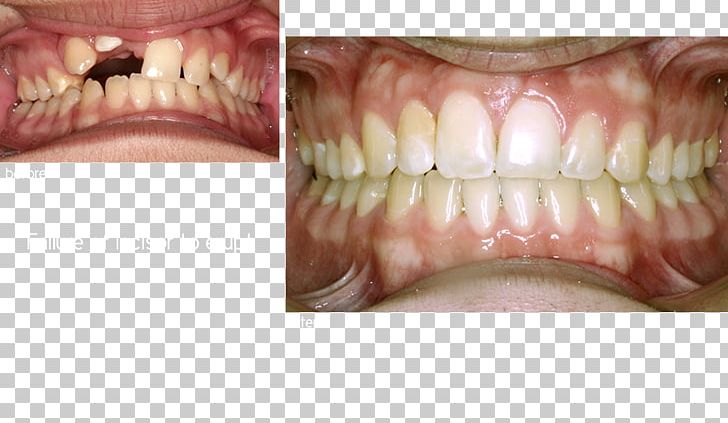 Human Tooth Dentures Close-up PNG, Clipart, Closeup, Closeup, Cosmetic Dentistry, Dastrup Kent A Dds, Dentistry Free PNG Download