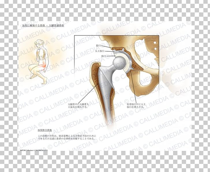 Bone Fracture Finger Femur Femoral Neck PNG, Clipart, Angle, Arm, Bone, Bone Fracture, Cartilage Free PNG Download
