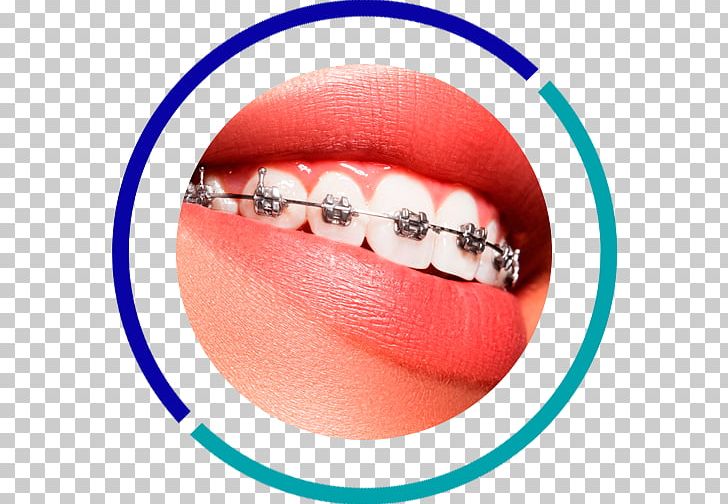 Orthodontics Dentistry Dental Braces Tooth PNG, Clipart, Body Jewelry, Caries, Clear Aligners, Clinic, Cosmetic Dentistry Free PNG Download