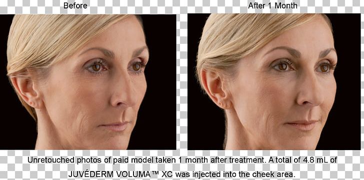 Injectable Filler Juvéderm Cheek Nasolabial Fold PNG, Clipart, Artefill, Before After, Cheek, Chin, Ear Free PNG Download