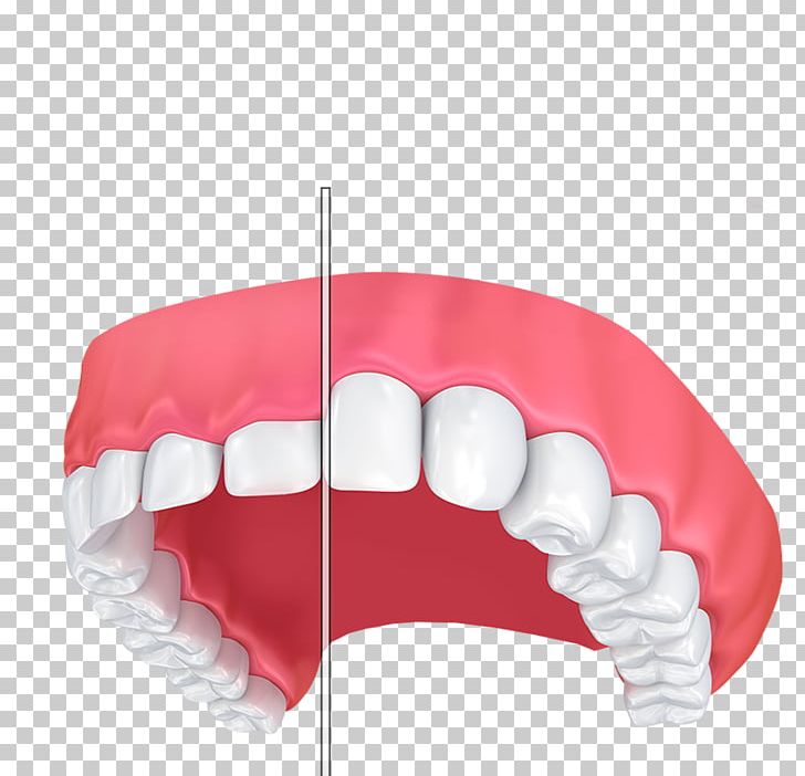 Gums Gum Lift Dentistry Tooth Gummy Smile PNG, Clipart, Contouring, Cosmetic Dentistry, Crown, Dentistry, Gingival Graft Free PNG Download