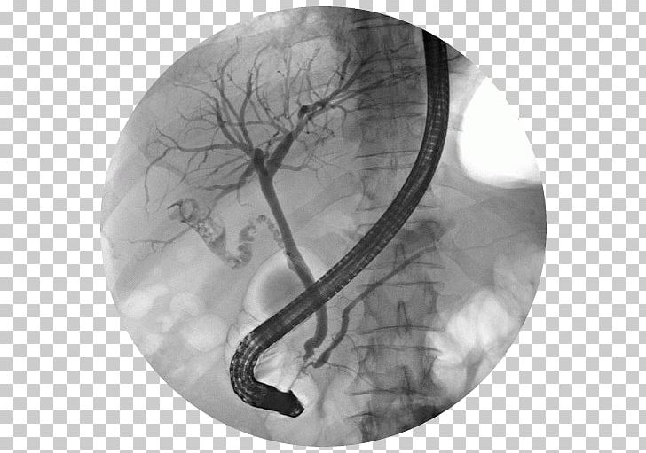 Endoscopic Retrograde Cholangiopancreatography Bile Duct Endoscopy Gallstone PNG, Clipart, Bile, Bile Duct, Biliary Tract, Black And White, Common Bile Duct Free PNG Download