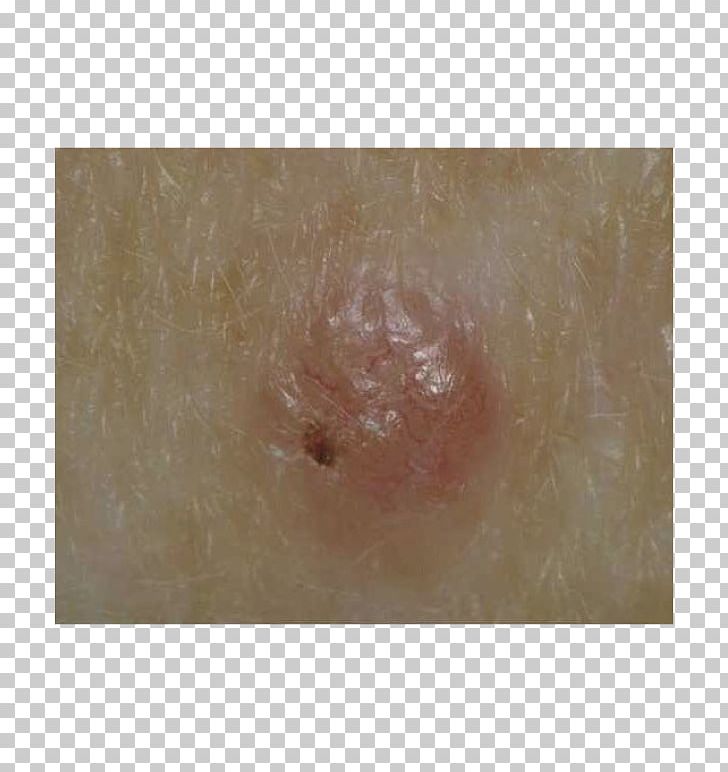 Skin Cancer Close-up Brown PNG, Clipart, Brown, Closeup, Closeup, Miscellaneous, Others Free PNG Download
