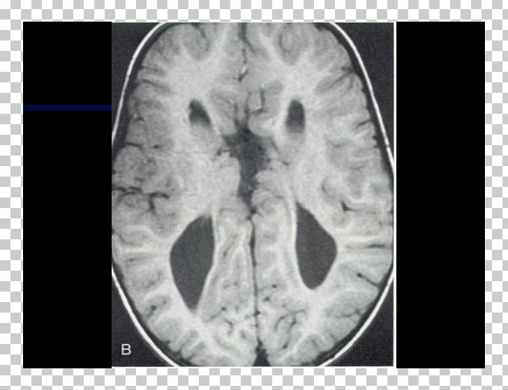 Computed Tomography Lääketieteellinen Röntgenkuvaus X-ray Brain Radiography PNG, Clipart, Black And White, Bone, Brain, Closeup, Computed Tomography Free PNG Download