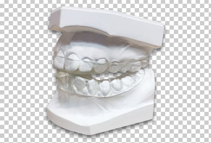Jaw Tooth Bruxism Dentistry Splint PNG, Clipart, Abfraction, Bruxism, Dental Laboratory, Dentist, Dentistry Free PNG Download