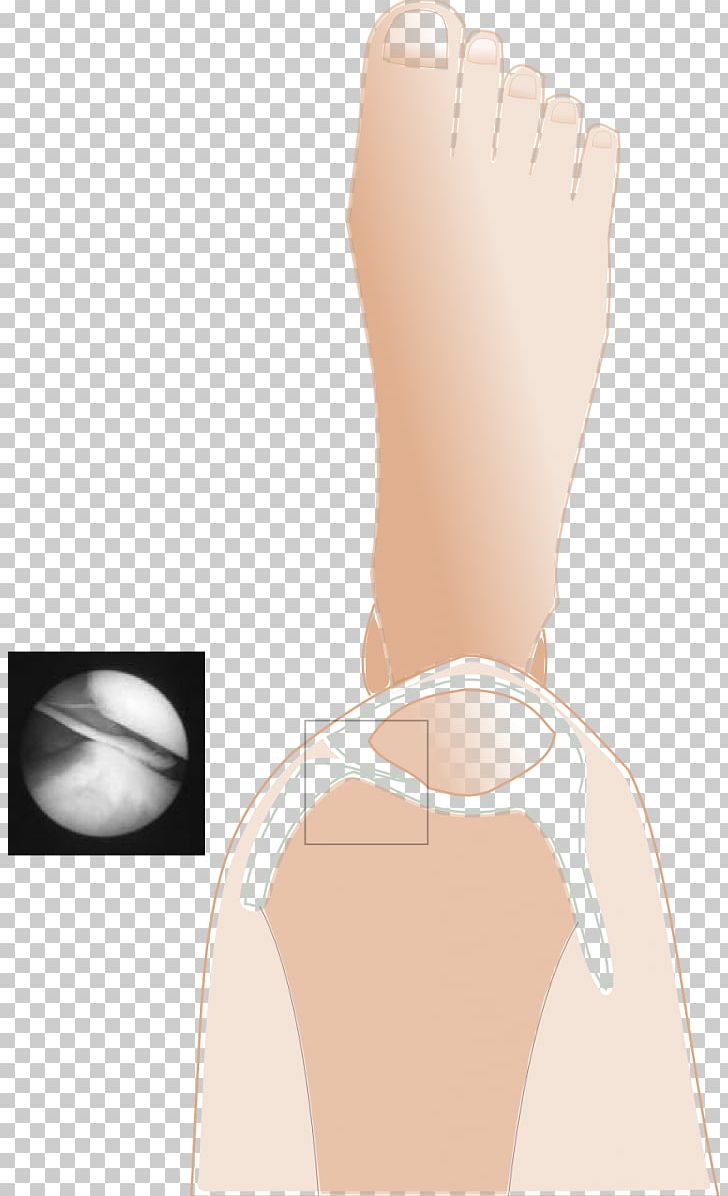 Thumb Plica Syndrome Knee Pain Patella PNG, Clipart, Active Undergarment, Arm, Chin, Finger, Get Elastic Free PNG Download