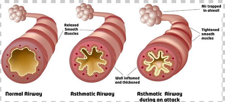 Cardiac Asthma Respiratory Tract Reactive Airway Disease Lung PNG, Clipart, Asthma, Breathing, Chronic Condition, Disease, Food Free PNG Download