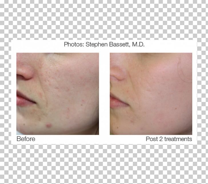 Facial Rejuvenation Face Wrinkle Lip PNG, Clipart, Cheek, Chin, Cosmetic Micro Surgery, Eyebrow, Eyelash Free PNG Download