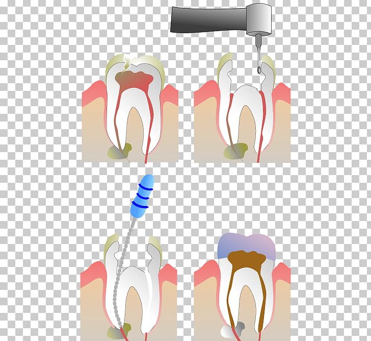 Endodontic Therapy Root Canal Dentistry PNG, Clipart, Dental Abscess, Dental Extraction, Dentist, Dentistry, Endodontics Free PNG Download