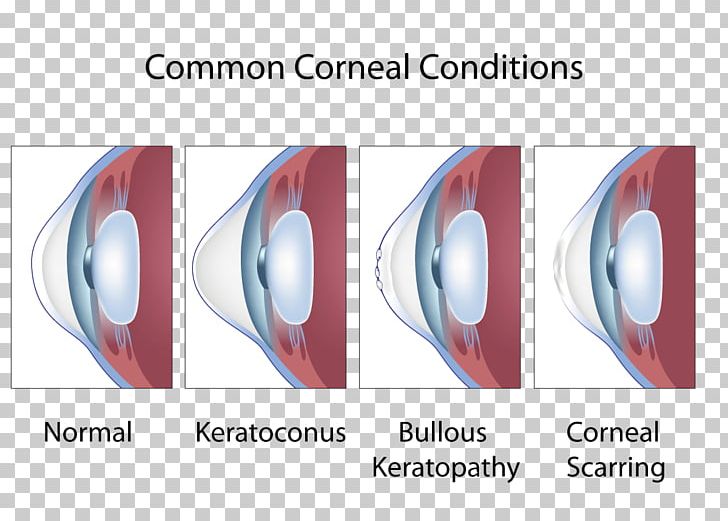 Keratoconus Cornea Symptom Eye Ophthalmology PNG, Clipart, Allergy, Contact Lenses, Cornea, Disease, Eye Free PNG Download