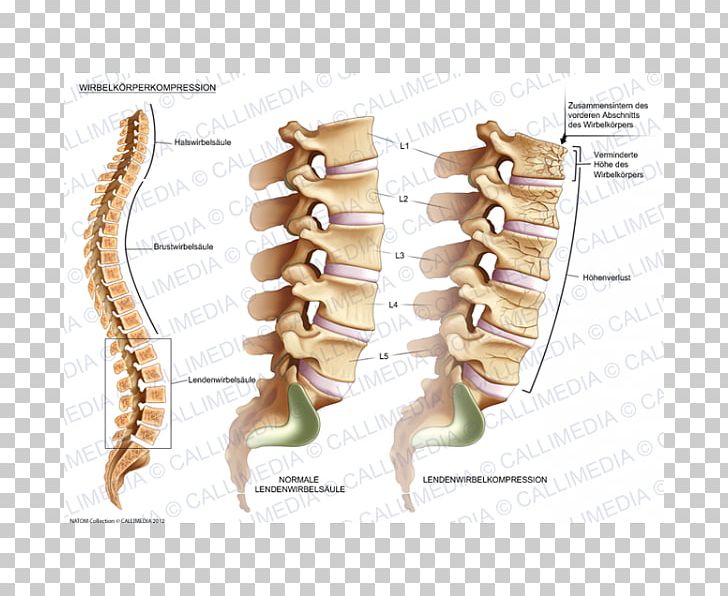 Vertebral Compression Fracture Vertebral Column Lumbar Vertebrae Bone Fracture PNG, Clipart, Bone, Bone Fracture, Cervical Vertebrae, Humerus, Injury Free PNG Download