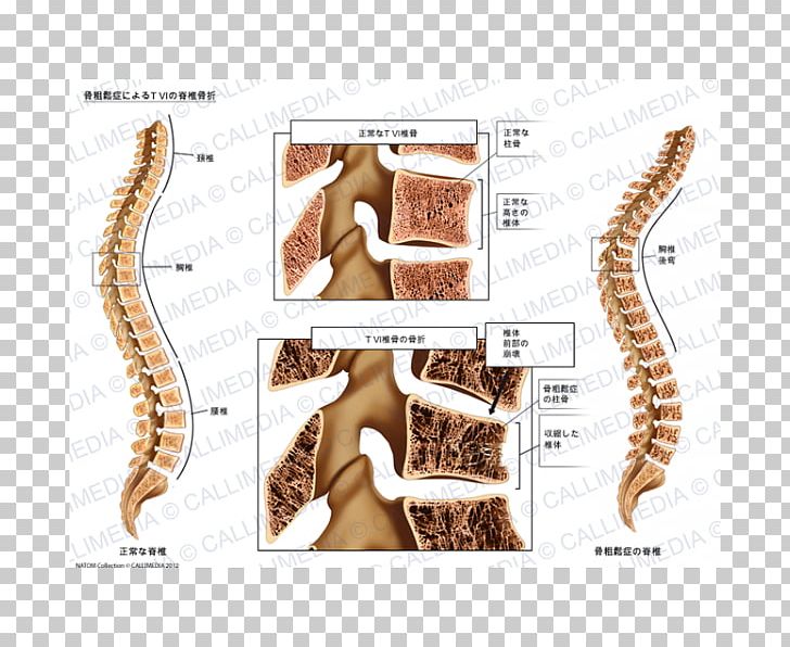 Bone Fracture Osteoporosis Vertebral Column Anatomy PNG, Clipart, Anatomy, Axis, Bone, Bone Fracture, Fauna Free PNG Download