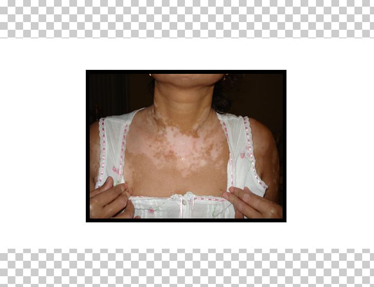 Vitiligo Disease Skin Therapy Health PNG, Clipart, Arm, Atopic Dermatitis, Berlin, Bilder, Bridal Clothing Free PNG Download