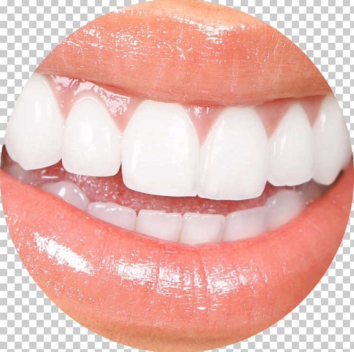 Veneer Cosmetic Dentistry Tooth Whitening PNG, Clipart, Cosmetic Dentistry, Crown, Dental Composite, Dental Implant, Dental Restoration Free PNG Download