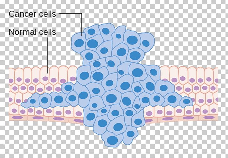 Cancer Cell Metastasis Neoplasm PNG, Clipart, Aloe, Aloe Vera, Area, Blue, Cancer Free PNG Download