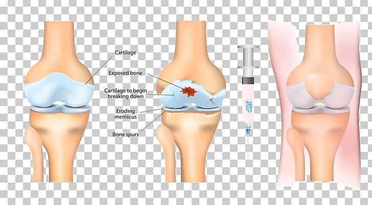 Stem-cell Therapy Osteoarthritis Platelet-rich Plasma Stem Cell Knee Arthritis PNG, Clipart, Active Undergarment, Arthritis, Brassiere, Cell, Cell Therapy Free PNG Download